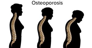Illustration showing the progression of osteoporosis in the human spine