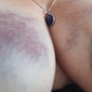 The after mark of a motorcycle accident to the female breast