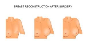 Breast Reconstruction After Surgery, Image by Dr. Garvit Chitkara